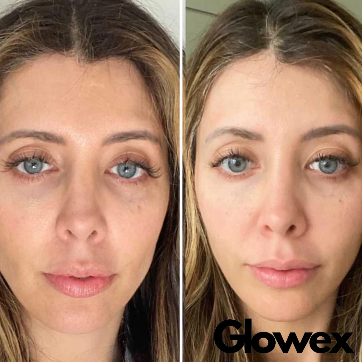 Eye-Glow Pro - Glowex | Acne-Vanish Pro, light therapy. Say Goodbye To Acne: Shop Glowex