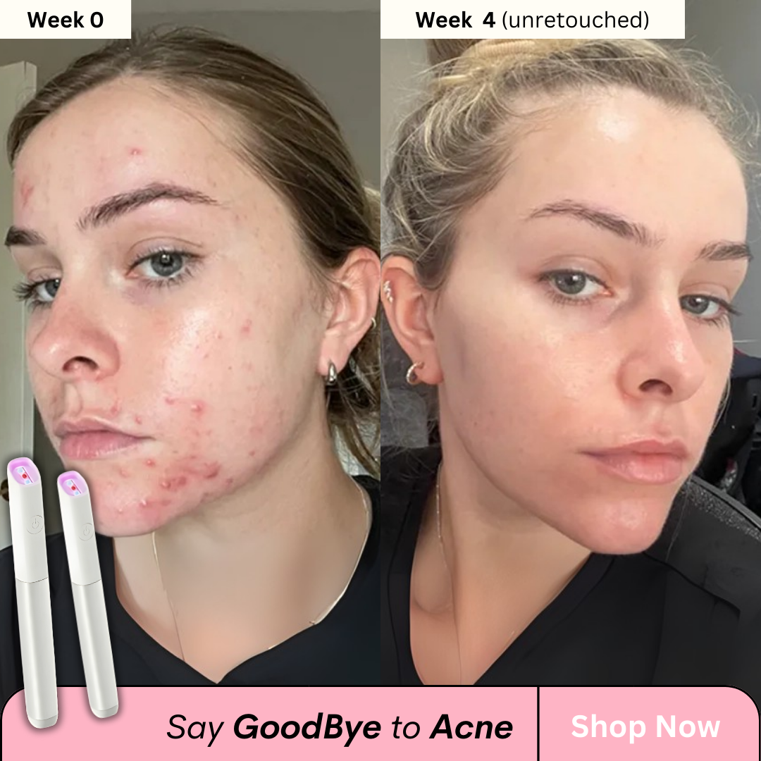 Acne-Vanish Pro