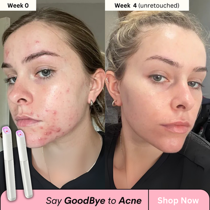 Acne-Vanish Pro